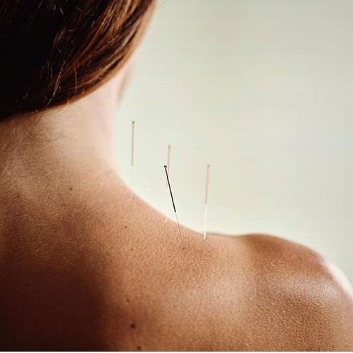 Acupuncture